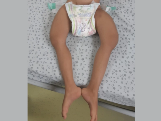 osteogenesis-imperfecta-understanding-causes-treatment-recover Dr. Venkat Ram Thyalapalli Best-treatment-for-osteogenesis-imperfecta-at-Banjara-Hills-and-Kukatpally